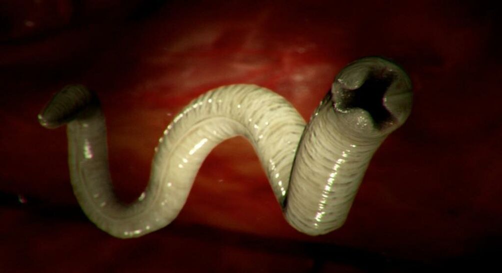 worms from human body